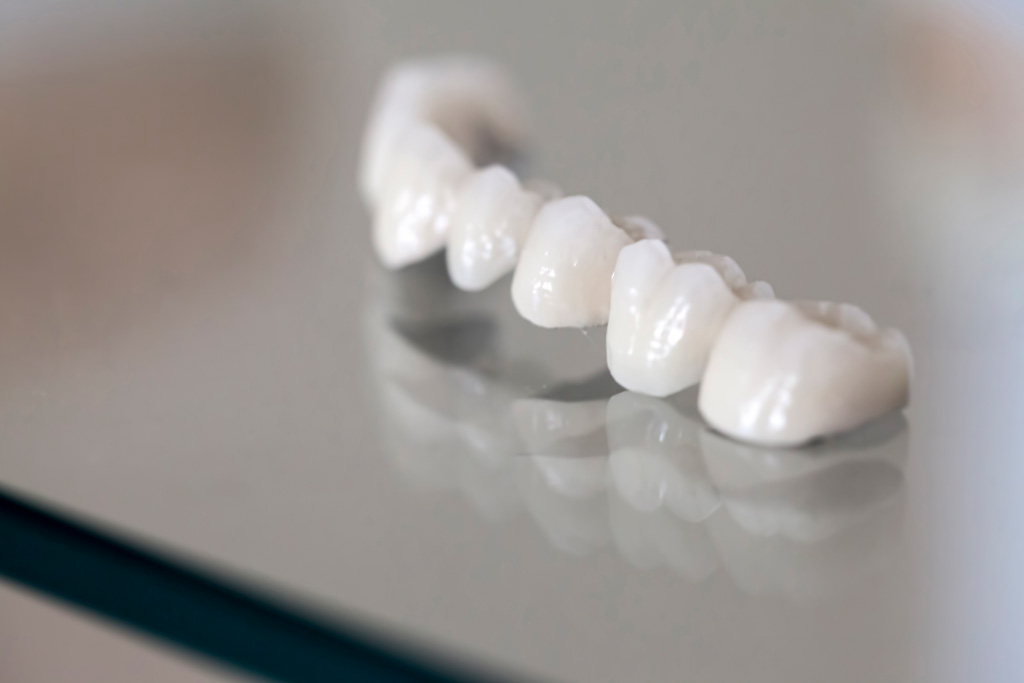 General Dentistry - Bridges